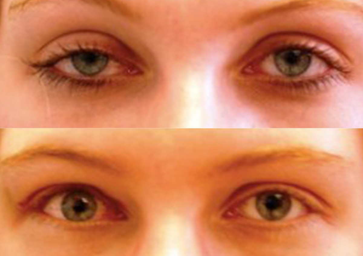 Eyelid treatment before and after.